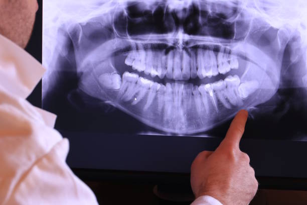 Best Emergency Wisdom Teeth Removal in Rolla, MO