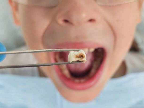 Best Emergency Tooth Extraction in Rolla, MO